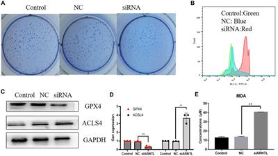 A ferroptosis-related gene signature and immune infiltration patterns predict the overall survival in acute myeloid leukemia patients